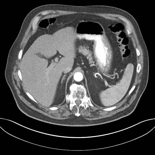 Adenocarcioma of rectum- T1 lesion (Radiopaedia 36921-38547 Axial C+ arterial phase 54).png
