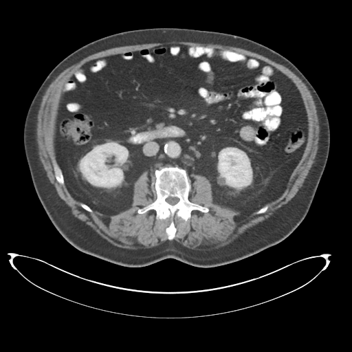 Adenocarcioma of rectum- T1 lesion (Radiopaedia 36921-38547 Axial C+ portal venous phase 41).png