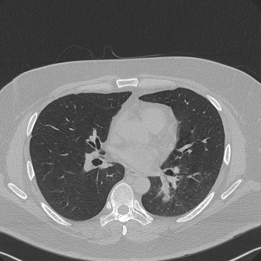 Adenoid cystic carcinoma of the trachea (Radiopaedia 49042-54137 Axial lung window 188).jpg