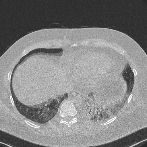 Adenoid cystic carcinoma of the trachea (Radiopaedia 49042-54137 Axial lung window 272).jpg