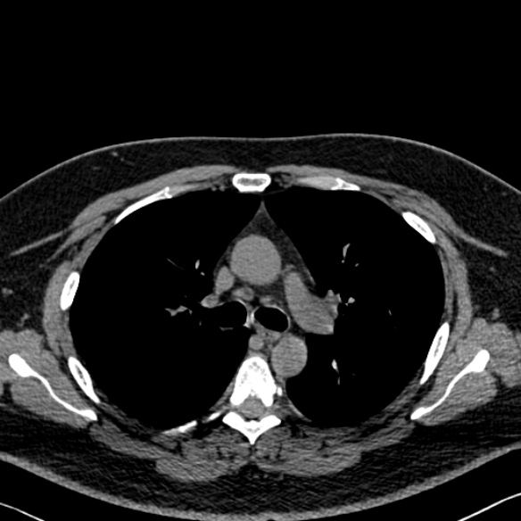 File:Adenoid cystic carcinoma of the trachea (Radiopaedia 49042-54137 Axial non-contrast 130).jpg