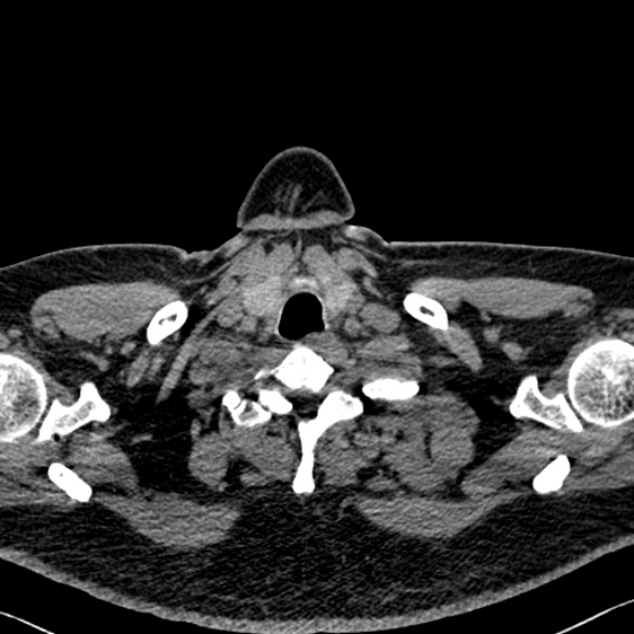 Adenoid cystic carcinoma of the trachea (Radiopaedia 49042-54137 Axial non-contrast 5).jpg