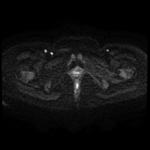 File:Adenoma malignum of cervix (Radiopaedia 66441-75705 Axial DWI 98).jpg