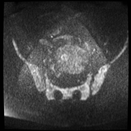 File:Adenomyosis-scar endometriosis (Radiopaedia 65863-75022 Axial DWI 2).jpg