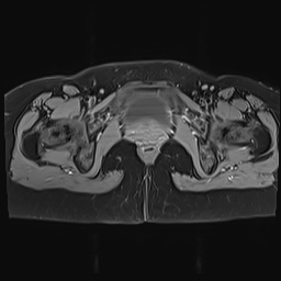 File:Adenomyosis and endometriotic cysts (Radiopaedia 82300-96367 Axial T1 C+ fat sat 2).jpg