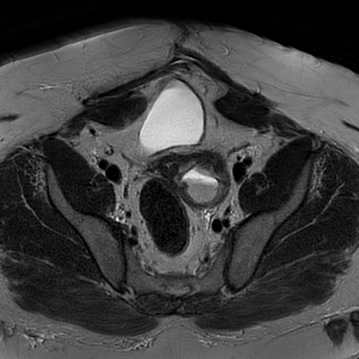File:Adenomyosis within a didelphys uterus (Radiopaedia 70175-80215 Axial T2 16).jpg