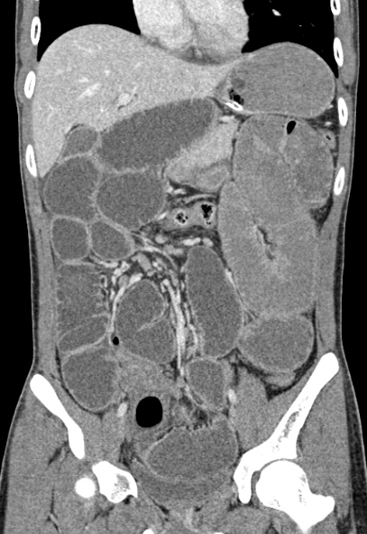 Adhesional small bowel obstruction (Radiopaedia 52107-57980 Coronal C+ portal venous phase 33).jpg