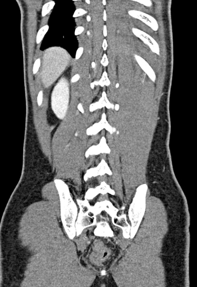 Adhesional small bowel obstruction (Radiopaedia 52107-57980 Coronal C+ portal venous phase 69).jpg