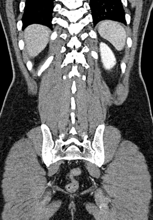 Adhesional small bowel obstruction (Radiopaedia 58900-66131 Coronal C+ portal venous phase 202).jpg