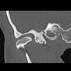 File:Adhesive chronic otitis media (Radiopaedia 14270-14148 Coronal bone window - right 1).jpg
