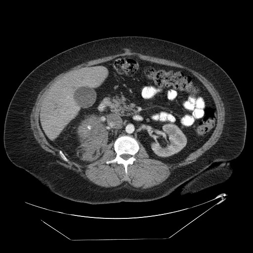 Adrenal angiosarcoma (Radiopaedia 81081-94671 Axial C+ arterial phase 34).jpg