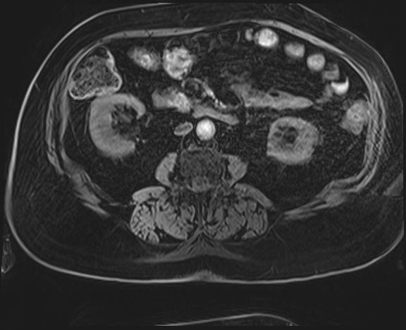 Adrenal cortical carcinoma (Radiopaedia 64017-72770 H 33).jpg