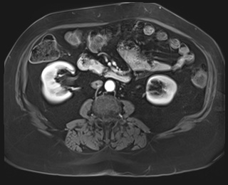 Adrenal cortical carcinoma (Radiopaedia 64017-72770 I 53).jpg