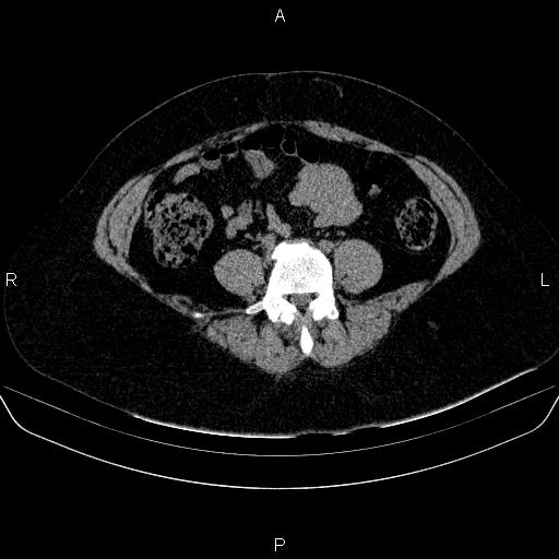 File:Adrenal cortical carcinoma (Radiopaedia 84882-100379 Axial non-contrast 60).jpg