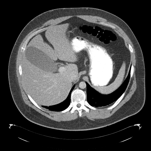 Adrenal cyst (Radiopaedia 45625-49776 Axial C+ portal venous phase 23).png