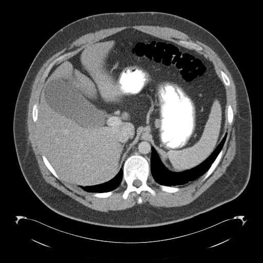 File:Adrenal cyst (Radiopaedia 45625-49776 Axial C+ portal venous phase 25).png