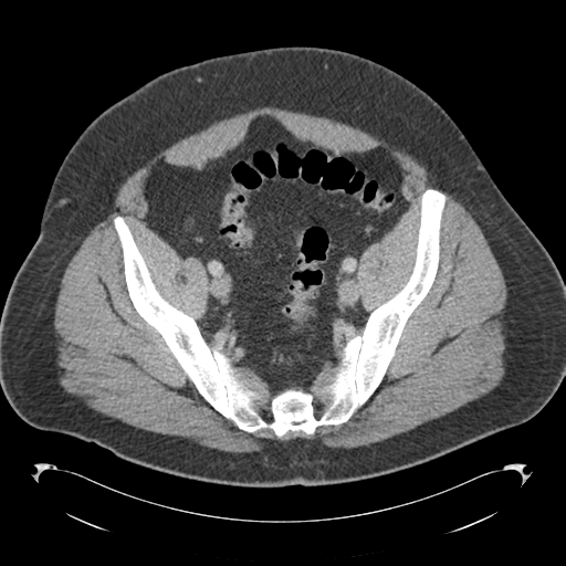 Adrenal cyst (Radiopaedia 45625-49776 Axial C+ portal venous phase 80).png