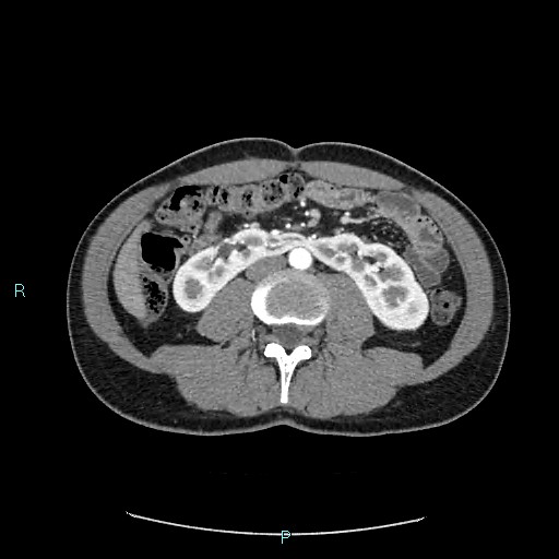 Adrenal cystic lymphangioma (Radiopaedia 83161-97534 Axial C+ arterial phase 50).jpg