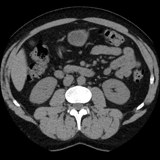 Adrenal gland trauma (Radiopaedia 81351-95079 Axial non-contrast 52).jpg