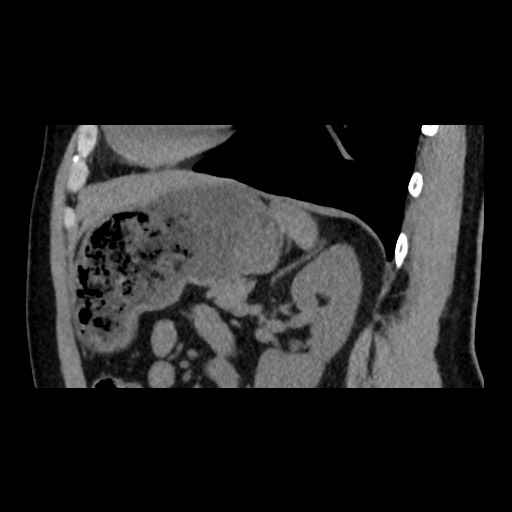 Adrenal gland trauma (Radiopaedia 81351-95079 Sagittal non-contrast 69).jpg