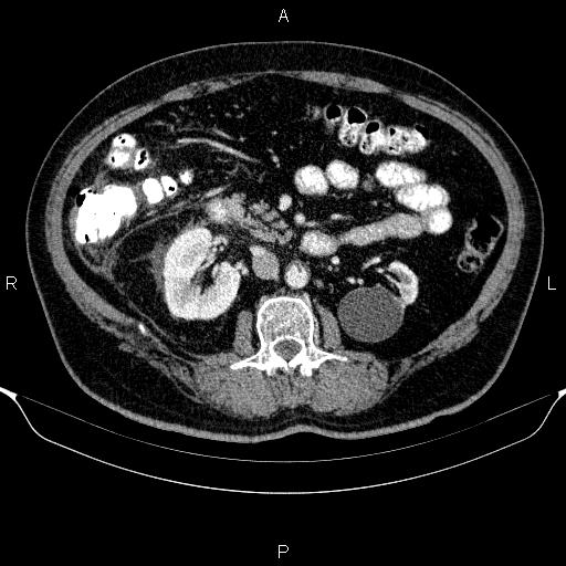 Adrenal hemorrhage (Radiopaedia 62622-70916 Axial C+ portal venous phase 84).jpg