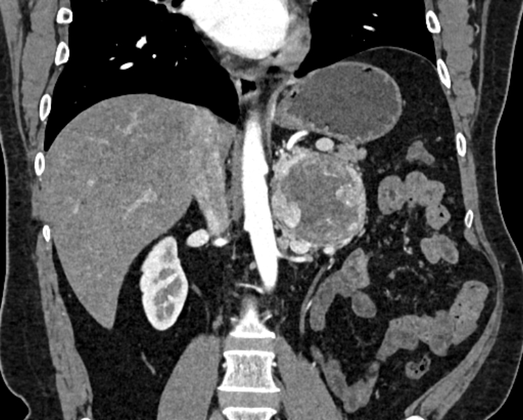 File:Adrenal metastases (Radiopaedia 73082-83791 Coronal C+ arterial phase 28).jpg