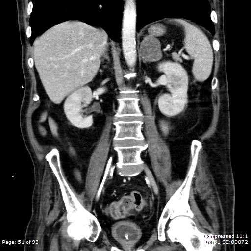 Adrenal metastasis (Radiopaedia 78425-91079 Sagittal C+ portal venous phase 38).jpg