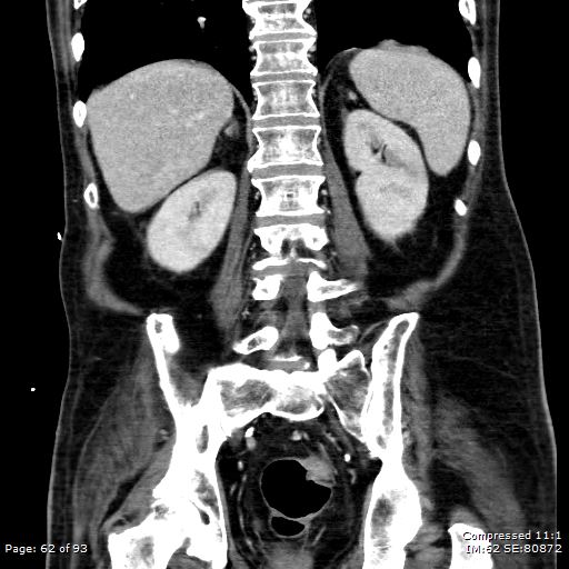Adrenal metastasis (Radiopaedia 78425-91079 Sagittal C+ portal venous phase 49).jpg