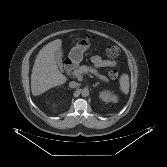 Adrenal myelolipoma (Radiopaedia 26278-26407 Axial non-contrast 20).jpg