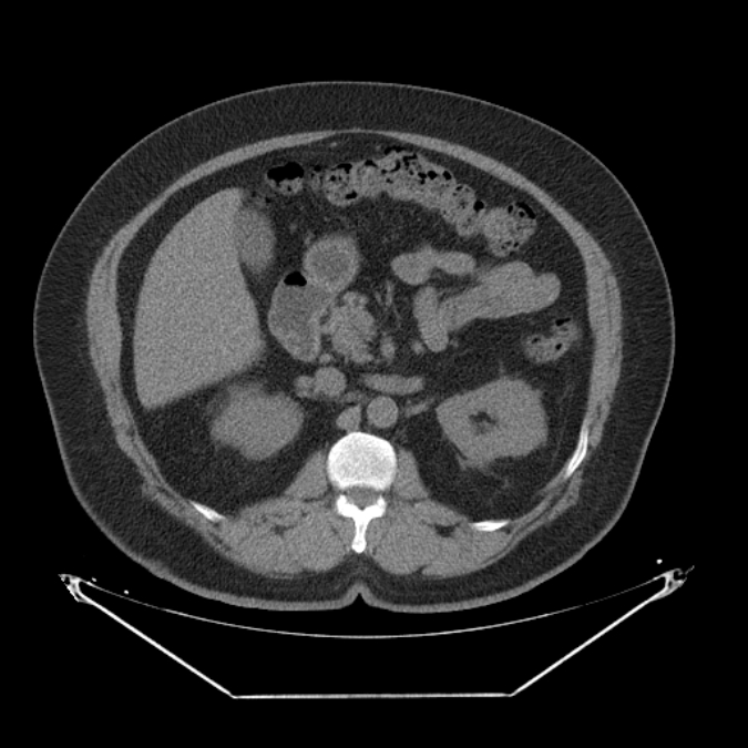 Adrenal myelolipoma (Radiopaedia 26278-26407 Axial non-contrast 24).jpg