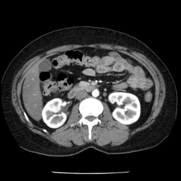 Adrenal myelolipoma (Radiopaedia 43401-46759 Axial C+ arterial phase 46).jpg