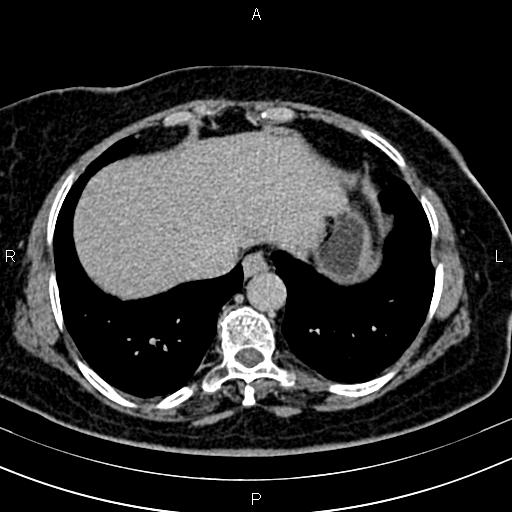 Adrenal myelolipoma (Radiopaedia 82742-96986 Axial renal excretory phase 5).jpg
