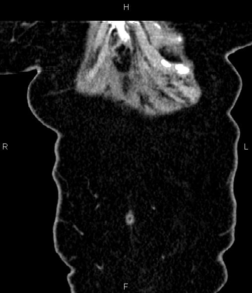 Adrenal myelolipoma (Radiopaedia 82742-96986 Coronal renal cortical phase 9).jpg