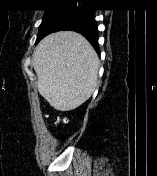 Adrenal myelolipoma (Radiopaedia 84319-99617 Sagittal renal cortical phase 11).jpg