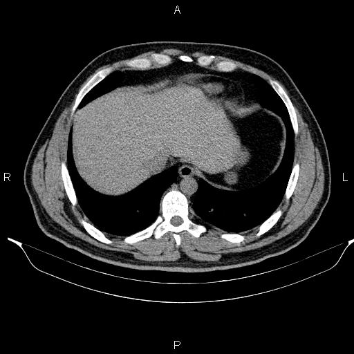 Adrenal myelolipoma (Radiopaedia 84321-99619 Axial non-contrast 15).jpg