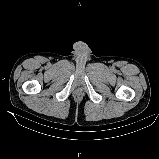 Adrenal myelolipoma (Radiopaedia 87794-104246 Axial non-contrast 117).jpg