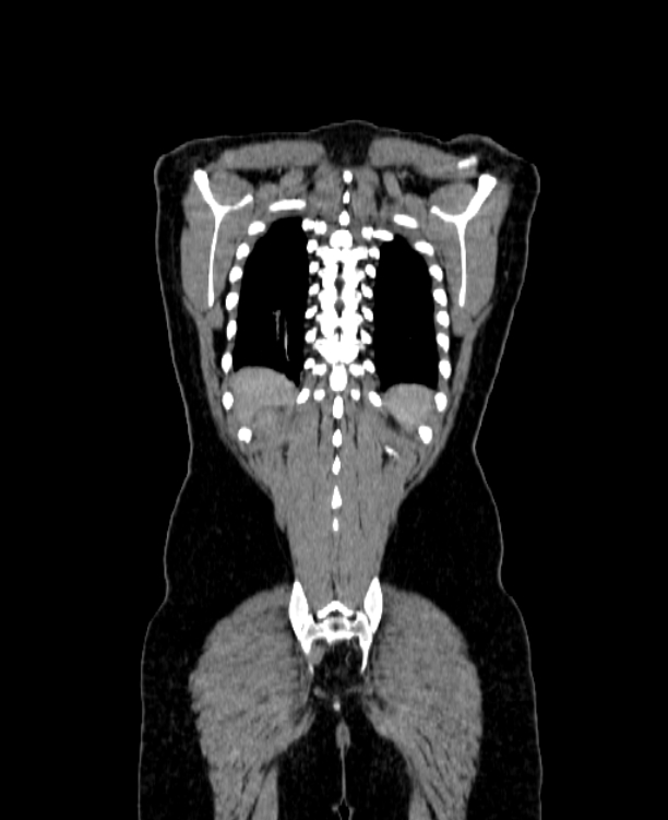 Adrenocortical carcinoma (Radiopaedia 80134-93438 Coronal C+ portal venous phase 143).jpg