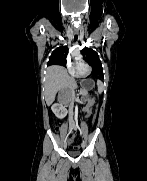 Adrenocortical carcinoma (Radiopaedia 80134-93438 Coronal C+ portal venous phase 81).jpg