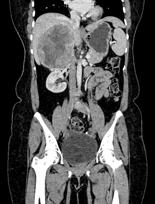 Adrenocortical carcinoma (Radiopaedia 87281-103569 Coronal C+ portal venous phase 49).jpg