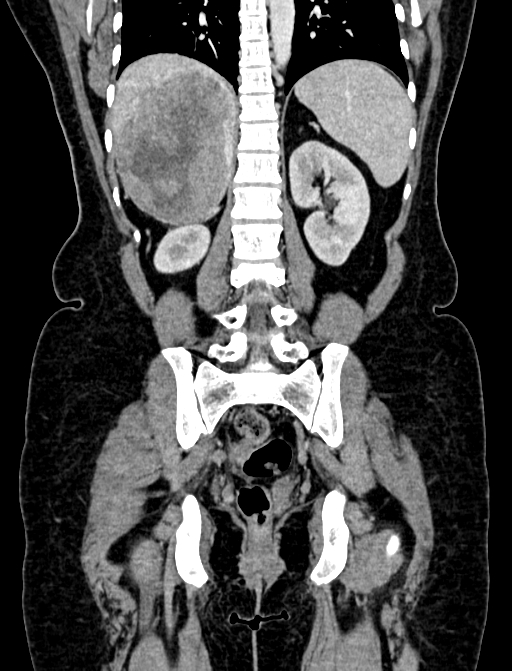 Adrenocortical carcinoma (Radiopaedia 87281-103569 Coronal C+ portal venous phase 93).jpg