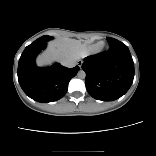 Adult polycystic kidney disease (Radiopaedia 48845-53876 Axial renal excretory phase 16).jpg