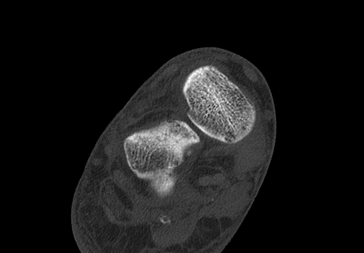 Advanced osteomyelitis due to open metatarsal fracture (Radiopaedia 83891-99095 Axial bone window 15).jpg