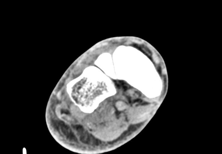 File:Advanced osteomyelitis due to open metatarsal fracture (Radiopaedia 83891-99095 Axial non-contrast 20).jpg