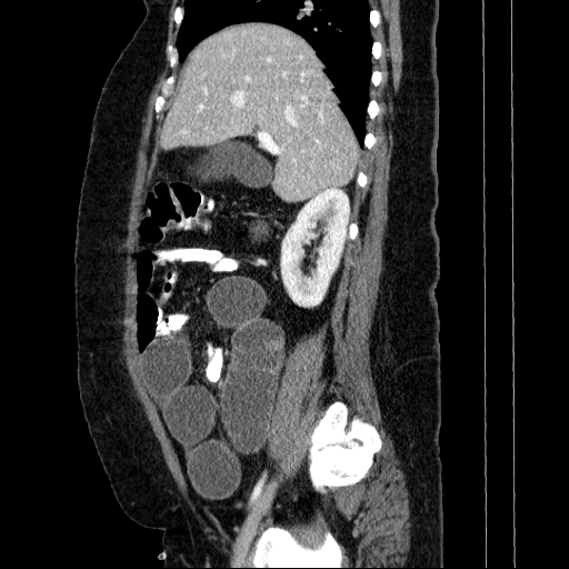 File:Afferent loop syndrome - secondary to incarcerated trocar site hernia (Radiopaedia 82959-97305 Sagittal C+ portal venous phase 104).jpg