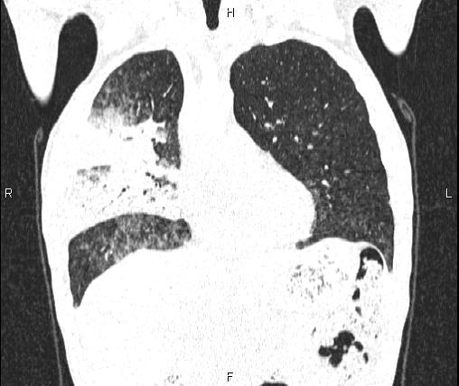 Air bronchogram in pneumonia (Radiopaedia 85719-101512 Coronal lung window 21).jpg