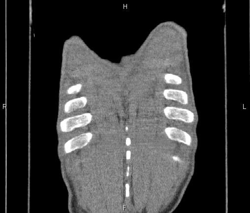 Air bronchogram in pneumonia (Radiopaedia 85719-101512 Coronal non-contrast 60).jpg