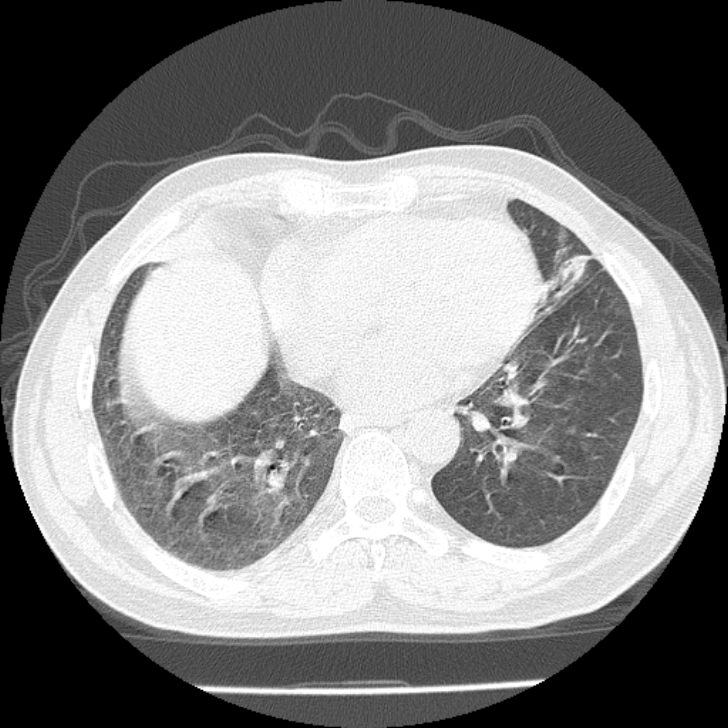 Airway foreign body in adult (Radiopaedia 85907-101779 Axial lung window 126).jpg