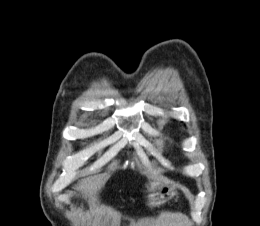 Airway foreign body in adult (Radiopaedia 85907-101779 Coronal liver window 7).jpg