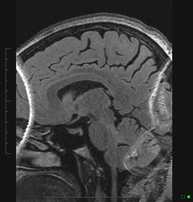 Aliasing artifact causing a spurious cerebellar lesion (Radiopaedia 48783-53810 Sagittal FLAIR 55).jpg