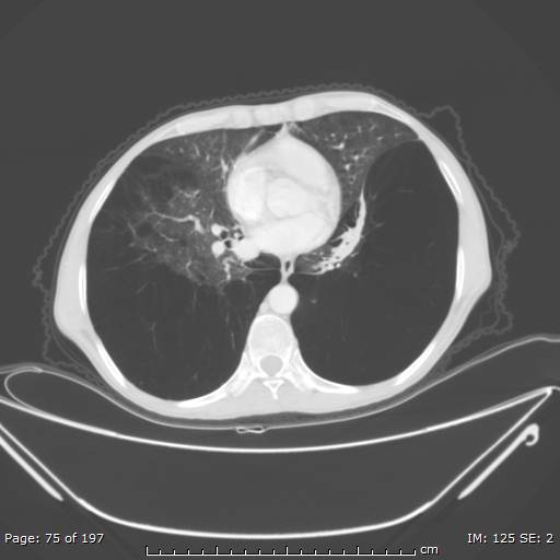 Alpha-1-antitrypsin deficiency (Radiopaedia 50561-55987 Axial lung window 32).jpg